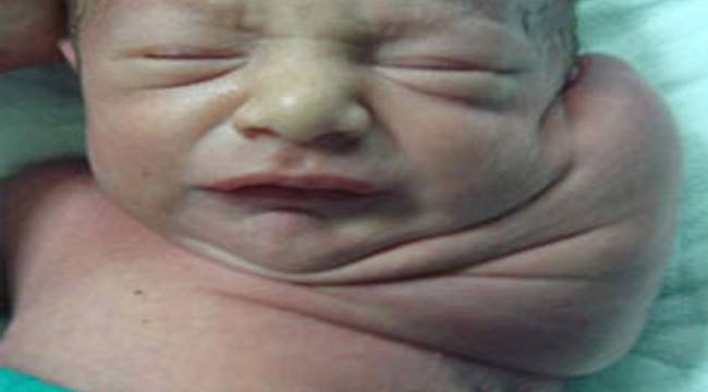 RİZE'DE 300 GR TÜMÖR İLE DOĞAN BEBEK AMELİYAT EDİLDİ