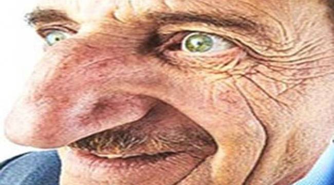 DÜNYANIN EN UZUN BURUNLU ADAMI DERTLİ